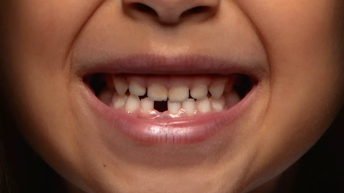 Dziecko połknęło zęba mlecznego? Sprawdź, co robić!